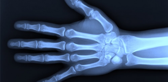 Webinar : Prevent osteoporosis